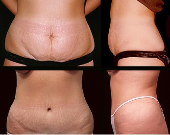 Tummy Tuck