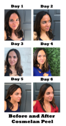 What You Need To Know About the Cosmelan Peel - Rockin Mama™