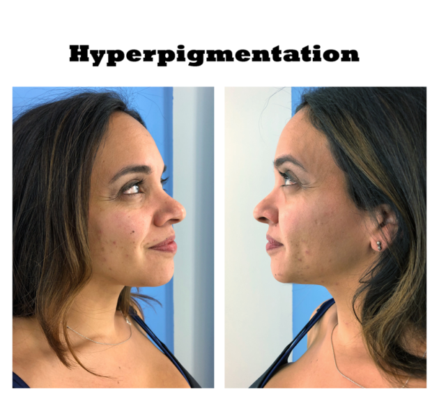Hyperpigmentation