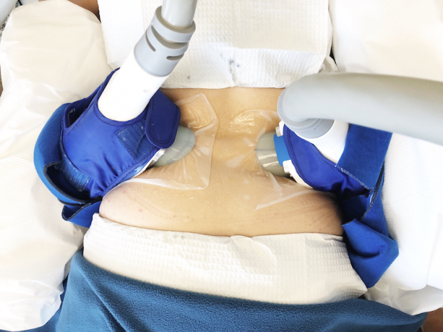 Coolsculpting Treatment