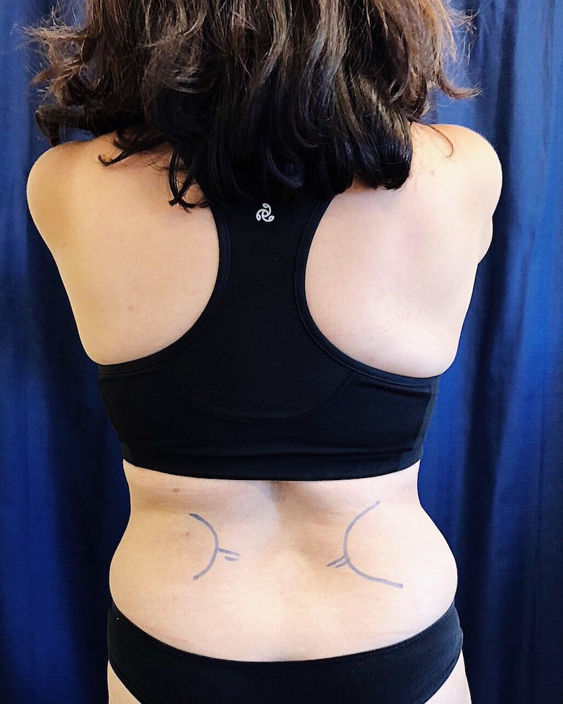Before CoolSculpting
