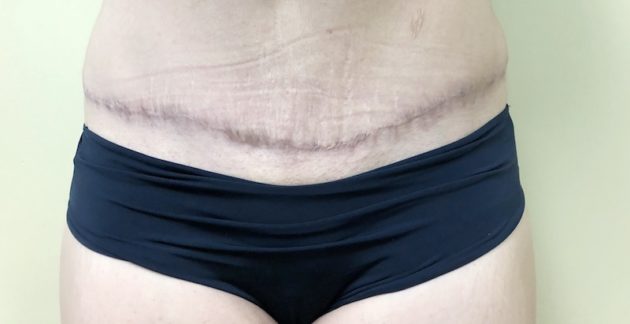 Tummy Tuck Scar