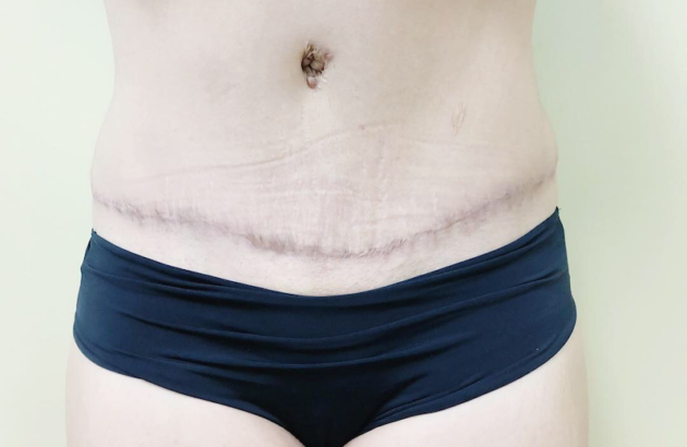 After Coolsculpting Cycles