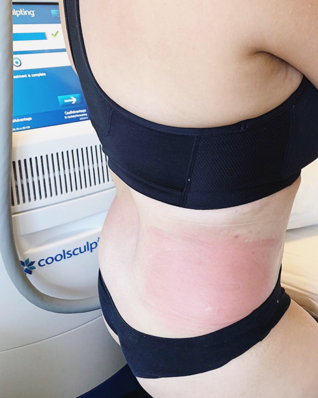 Redness After Coolsculpting